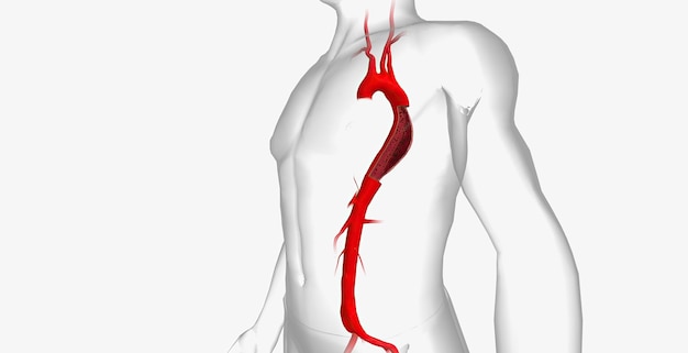 Aortadissectie is een ernstige cardiovasculaire aandoening die wordt gekenmerkt door een scheur in de binnenste laag van de aorta