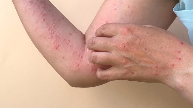 Apenpokkenvirus een nieuw wereldprobleem van de moderne mensheid Close-up van de handen van een zieke met puistjes en blaren
