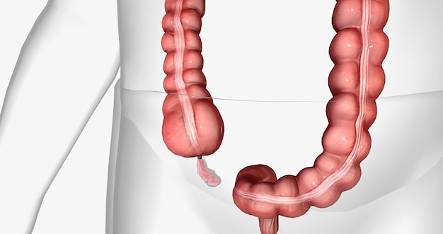 Appendicitis Accumulation of Inflammatory Fluid