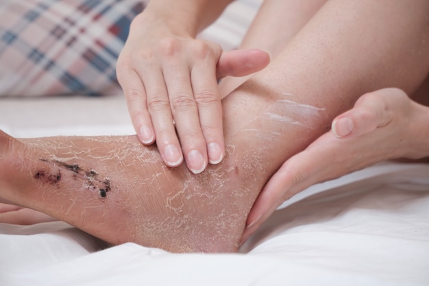 Нанесение крема на поврежденную кожу ноги. Реабилитация после снятия гипсовой повязки