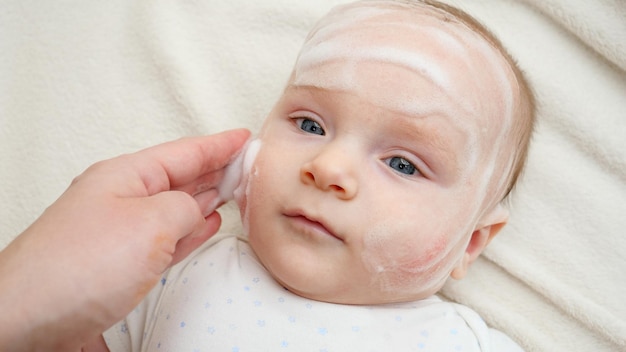 写真 皮膚炎やニキビに悩む赤ちゃんの頬に硬化ローションや軟膏を塗る