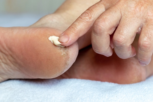 Applying ointment on the heel with a crack