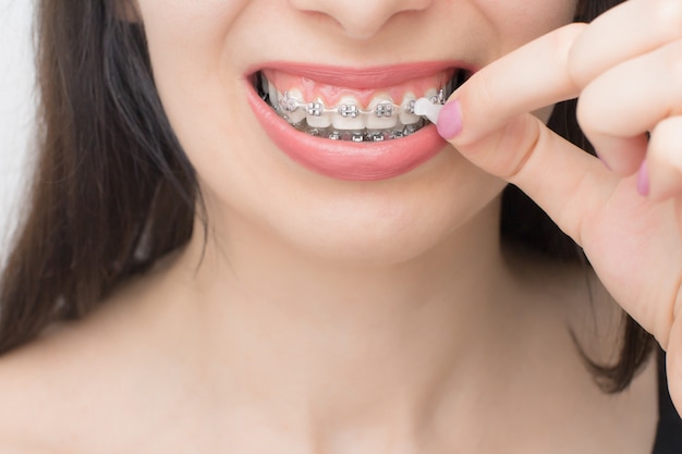 Applying orthodontic wax on the dental braces. Brackets on the teeth after whitening. Self-ligating brackets with metal ties and gray elastics or rubber bands for perfect smile.