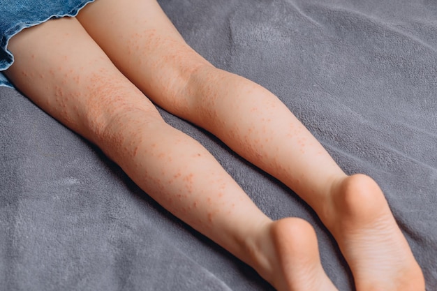 An approximate photo of a little girl's legs covered with porphyria Pigmented red spots on the surface of the legs