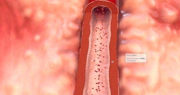 Artery dilates due to increase of ARBs in the blood