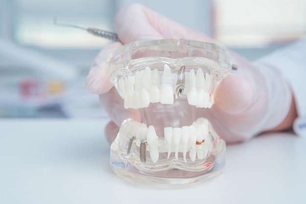 Arts-orthodontist houdt in zijn hand een model van tanden met implantaten