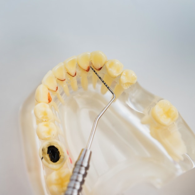 Arts-orthodontist toont het instrument op cariës in de tanden