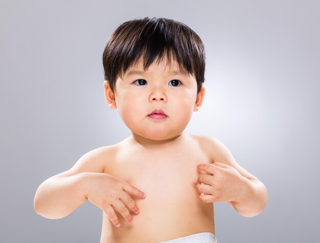 Asian baby with skin problem