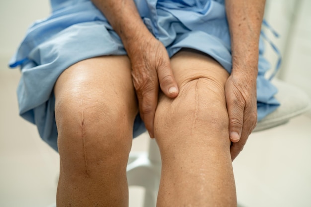 Азиатская пожилая женщина-пациент показывает свои шрамы хирургическая полная замена коленного сустава хирургическая операция шитья раны артропластика на постели в больнице