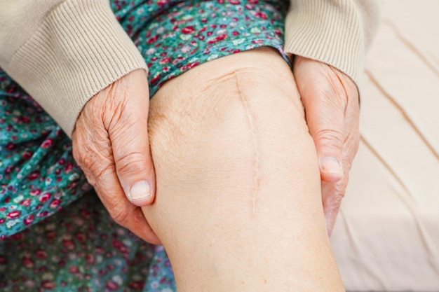 Asian elderly woman patient with scar knee replacement surgery in hospital