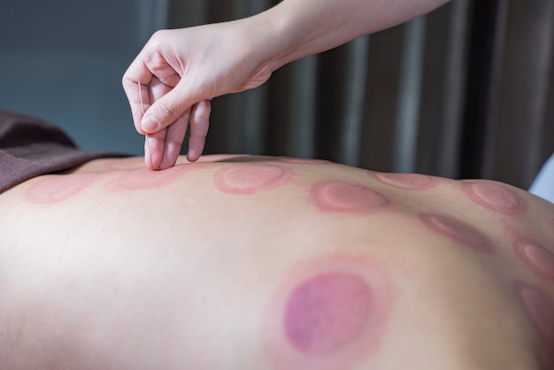 Cupping treatme 후 건강 스파 마사지에서 침술 치료를 받고 아시아 남자