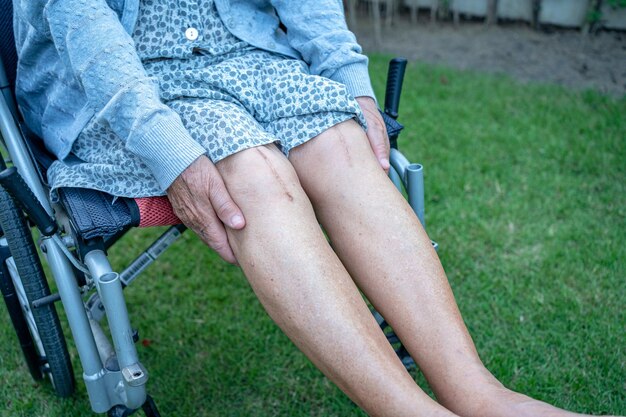 Photo asian senior or elderly old lady woman patient show her scars surgical total knee joint replacement suture wound surgery arthroplasty on bed in nursing hospital ward healthy strong medical concept