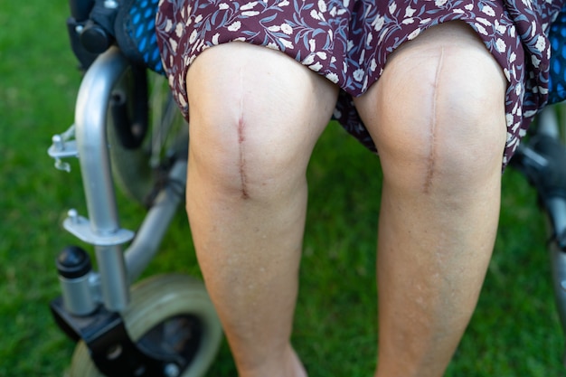 Photo asian senior or elderly old lady woman patient show her scars surgical total knee joint replacement suture wound surgery arthroplasty on bed in nursing hospital ward, healthy strong medical concept.