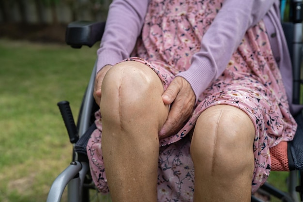 아시아 노인 또는 노인 여성 환자는 요양 병원 병동의 침대에서 흉터 수술 총 무릎 관절 교체 봉합 상처 수술 인공 관절을 보여 건강하고 강한 의료 개념