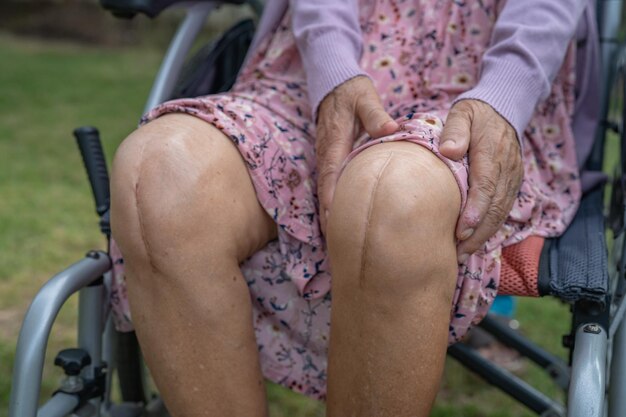 Foto paziente asiatico anziano o anziano donna mostra le sue cicatrici sostituzione chirurgica totale dell'articolazione del ginocchio artroplastica chirurgica della ferita di sutura sul letto nel reparto di cura dell'ospedale sano concetto medico forte