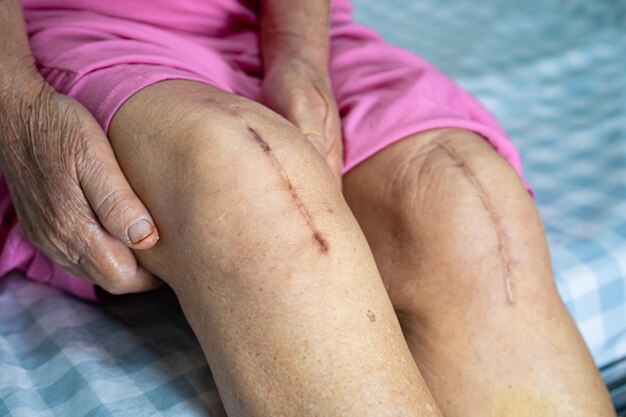 Photo asian senior or elderly old lady woman patient show her scars surgical total knee joint replacement suture wound surgery arthroplasty on bed in nursing hospital ward healthy strong medical concept