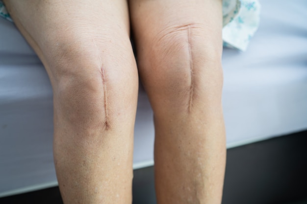 アジアのシニアまたは高齢の老婦人女性患者は、彼女の傷跡を外科的膝関節全置換術で示しています