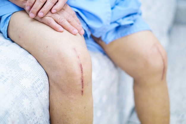 Asian senior lady old woman patient show her scars surgical total knee joint replacement.