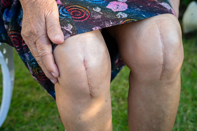 Asian senior lady old woman patient show her scars surgical total knee joint replacement.