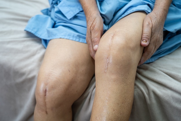 아시아 노인 여성 환자는 그녀의 흉터 수술을 보여줍니다. 전체 무릎 관절 교체 봉합 상처 수술