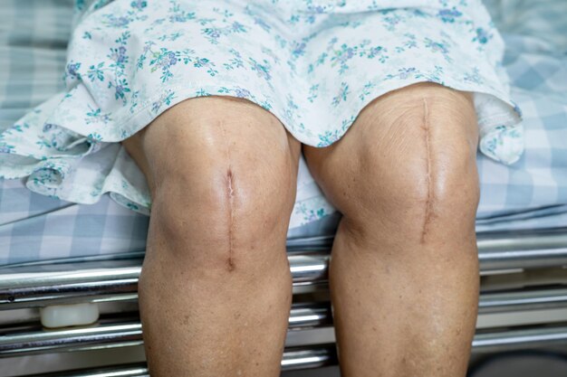 アジアの高齢女性患者は手術による膝関節の完全置換の傷跡を示しています