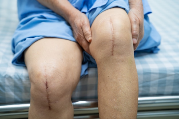 Asian senior woman patient show her scars surgical total knee joint replacement .