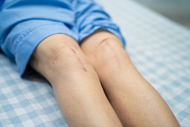 Il paziente asiatico senior della donna le mostra la sostituzione totale chirurgica dell'articolazione del ginocchio delle cicatrici.