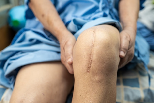 Asian senior woman patient show her scars surgical total knee joint replacement.