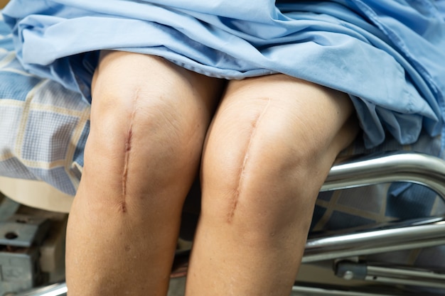 アジアの年配の女性患者は、彼女の傷跡の外科的膝関節全置換術を示しています。