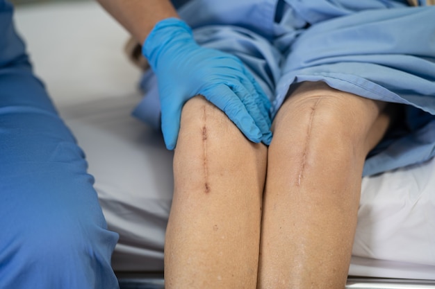 Asian senior woman patient show her scars surgical total knee joint replacement.