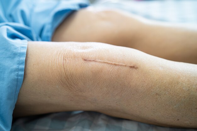 Photo asian senior woman patient show her scars surgical total knee joint replacement