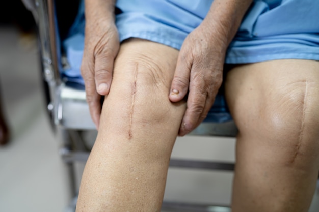 Asian senior woman patient show her scars surgical total knee joint replacement