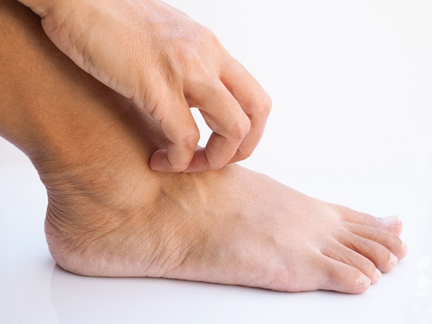 Asian thai woman itch and scratch on feet, Skin disease, dry skin or insect bites at foot.