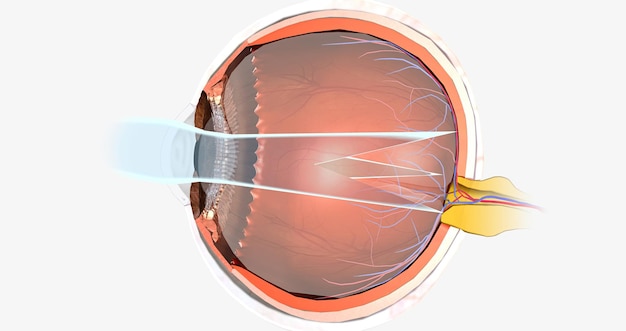 Foto astigmatisme is een oogaandoening die wordt gekenmerkt door een ovaalvormig hoornvlies en wazig zicht