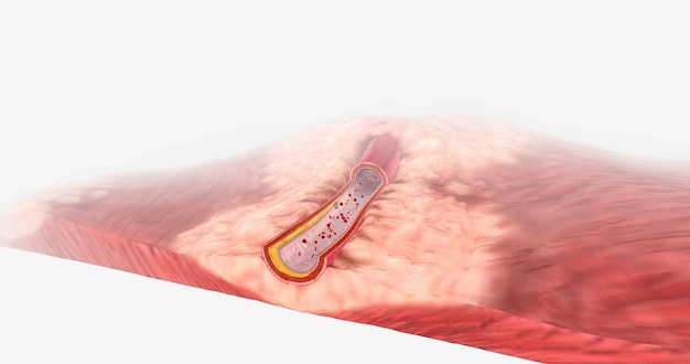 Atherosclerosis can sometimes narrow arteries that blood to the heart is restricted