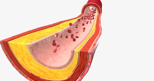 アテローム血栓症は、アテローム性動脈硬化性プラークの破裂と血栓形成を特徴とする心血管疾患です。