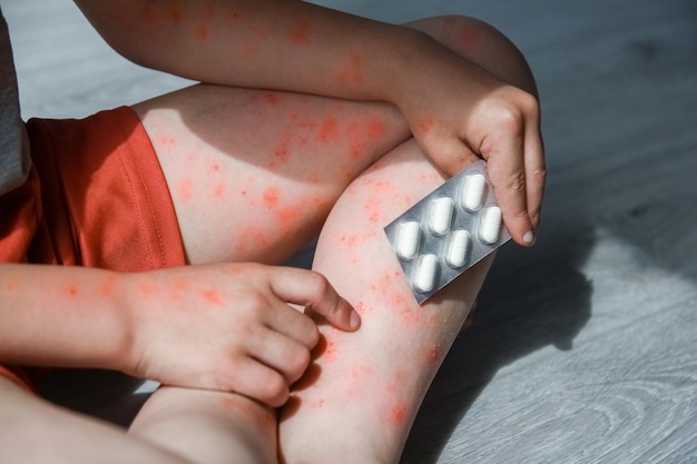 Photo atopic dermatitis on the legs of a child treatment