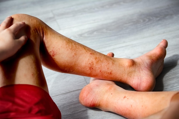 Atopic dermatitis on the legs of a child