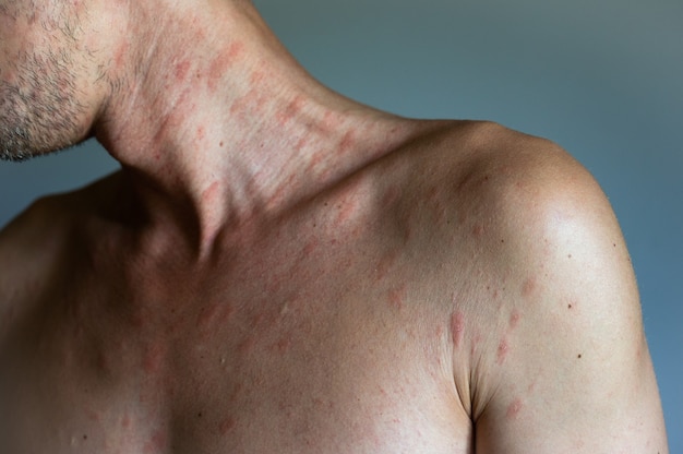 Struttura di allergia dell'eczema atopico della pelle umana malata. uomo con sintomi di orticaria pruriginosa.