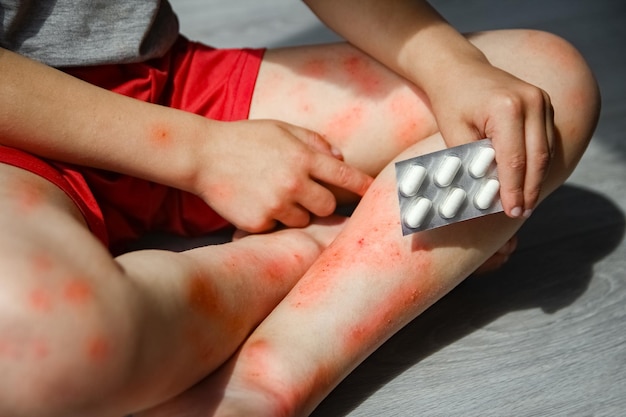 atopische dermatitis op de benen van een kinderbehandeling