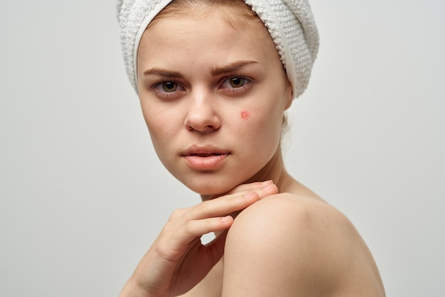 Attractive woman with towel on head naked shoulders pimples on\
face acne skin care