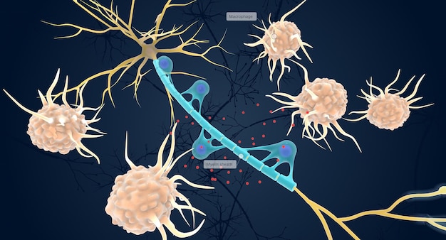 Photo autoimmune attack on myelin sheath