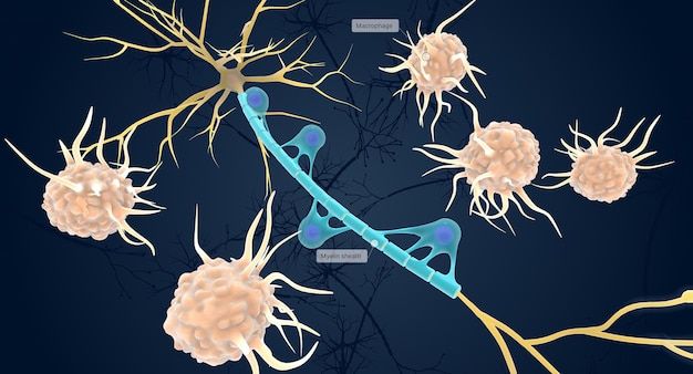 Autoimmune Attack on Myelin Sheath