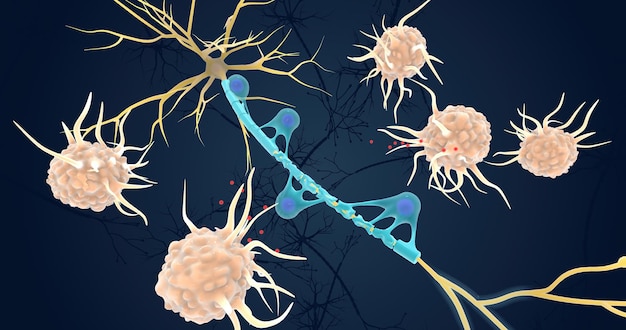 Photo autoimmune attack on myelin sheath