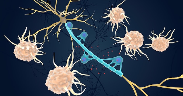 Photo autoimmune attack on myelin sheath