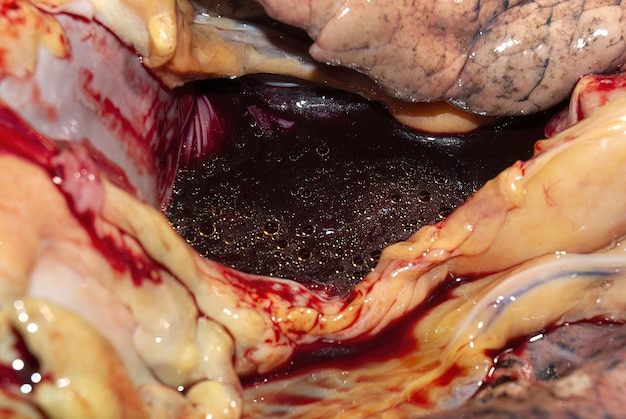 Photo autopsy of a corpse thoracic cavity cardiac suffering fat in the blood cholesterolemia heart attack