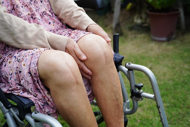 Aziatische oudere vrouw patiënt met litteken knie vervangende operatie in het ziekenhuis