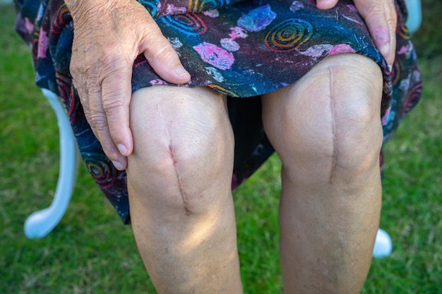 Aziatische senior dame oude vrouw patiënt toont haar littekens chirurgische totale kniegewricht vervanging.