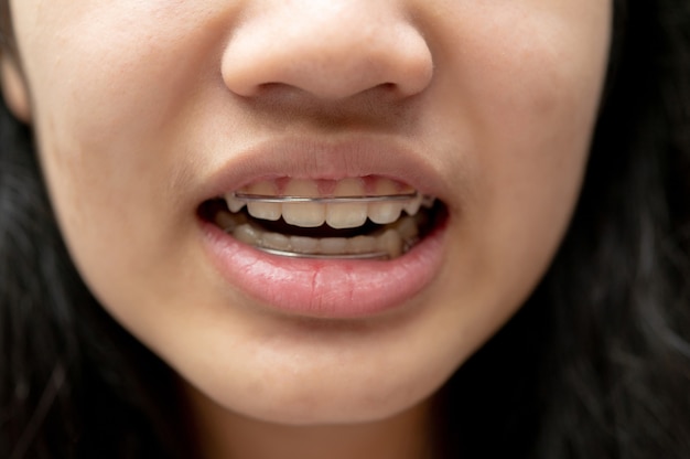 Aziatische tienervrouw die orthodontische houders draagt