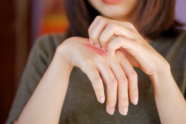 Aziatische vrouw krabt aan een hand met een rode uitslag op de rug van de hand als gevolg van een allergie voor een vreemd lichaam of een insectenbeet.